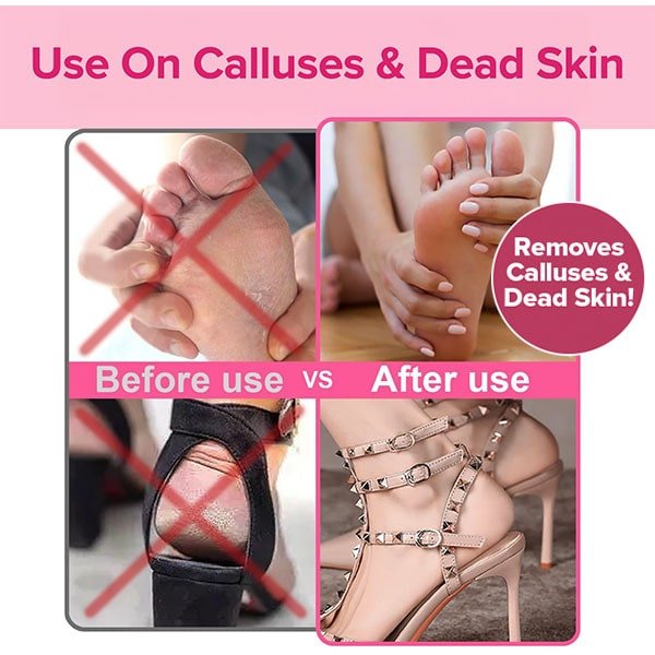 Electric Callus Remover